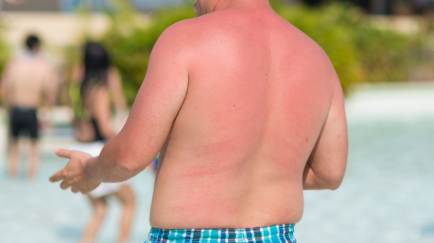 På sikt påskyndar flitigt solande hudens åldrande och risken för uppkomst av hudtumörer ökar, särskilt om man ofta blivit bränd av solen Foto: Shutterstock